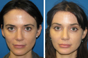 Before & After Photos